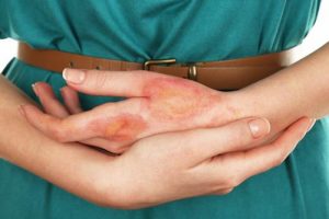 Making an Injury Claim for Burns and Scars after an Accident in Georgia