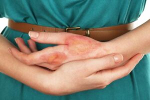 Blog making an injury claim for burns and scars after an accident in georgia 2