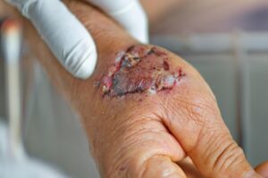 Why do I Need a Dog Bite Lawyer?