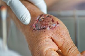 Statute of Limitations for Dog Bite Injuries
