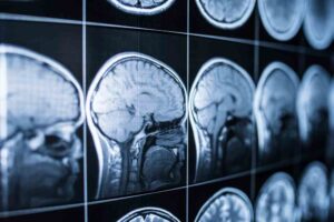 Athens Traumatic Brain Injury Lawyers | John Foy & Associates x-rays of brains of patients