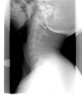 What to Do If Your Neck Hurts After a Car Accident in Georgia I was in a car accident in georgia and my neck hurts what should i do