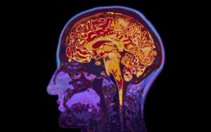 Traumatic Brain Injury Lawyer in Lithonia | 24/7 Help MRI of a brain