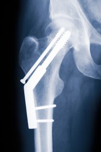 hip x-ray showing surgical implants