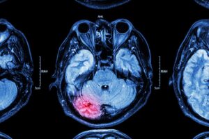 College Park Traumatic Brain Injury Lawyers | John Foy mri showing brain injury
