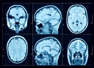 Traumatic Brain Injury Lawyer in Acworth | Free Eval ct scan of a brain