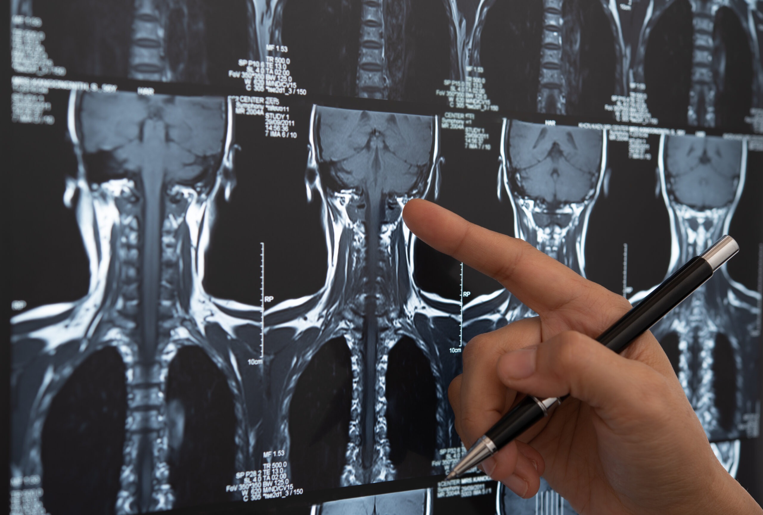 How Much Compensation Will I Get For Fractured Pelvis Fairmont thumbnail