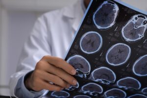 Can I Sue for a Concussion?