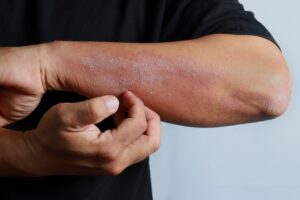 What Skin Conditions Qualify for Workers’ Compensation?
